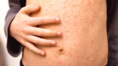 Confirman primer caso de sarampión en Ocotlán. Foto: Ilustatriva, propiedad Gaceta UNAM.